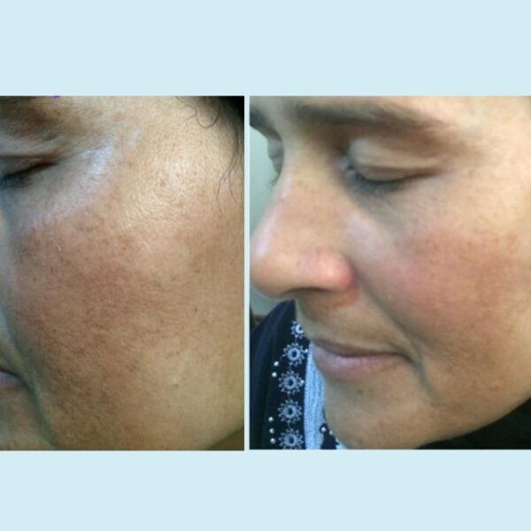 Lactic 50% Gel Peel, Chemical Peels for Face Breakout Scars, Chemical Exfoliant for Face, Strength Level 2, 1.0 fl oz. e, 30 mL ? Perfect Image - Image 4