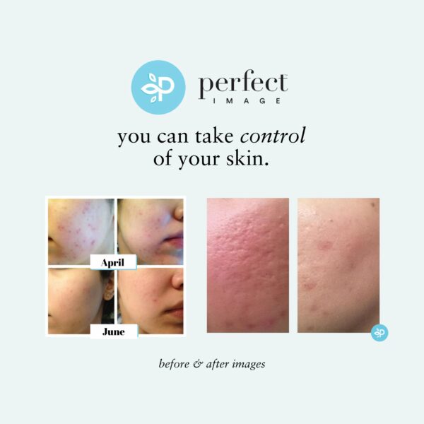 Lactic 50% Gel Peel, Chemical Peels for Face Breakout Scars, Chemical Exfoliant for Face, Strength Level 2, 1.0 fl oz. e, 30 mL ? Perfect Image - Image 5